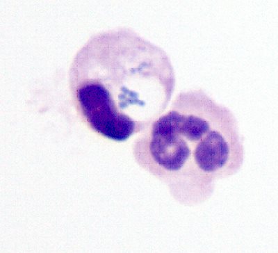 A neutrophil and a bacteria-engulfing macrophage sorted from sputum of a person with cystic fibrosis